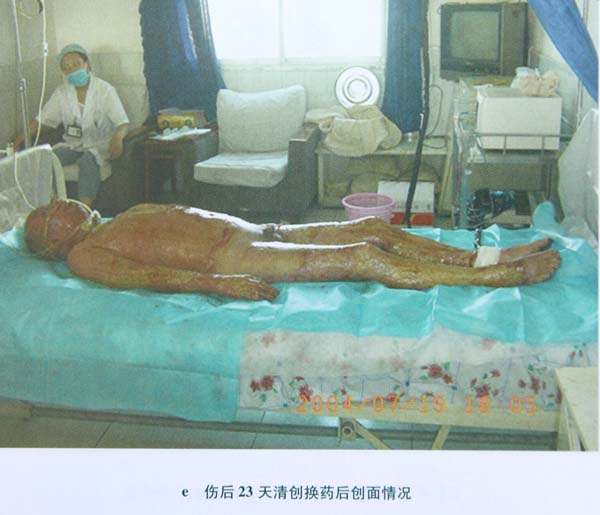 第一节 特大面积烧伤病例(1)治疗记录_在线阅读_美宝国际集团